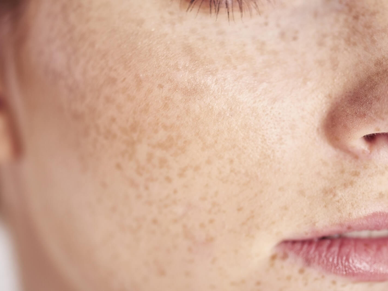 Lợi ích của lợi khuẩn (men vi sinh) với làn da Lợi ích của lợi khuẩn (men vi sinh) với làn da