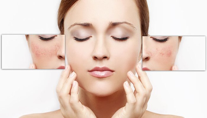 Chăm sóc da nám đúng cách bằng việc bôi kem dưỡng ẩm phù hợp